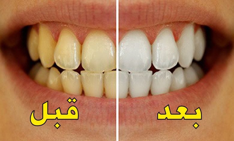 4 وصفات طبيعية لتبيض الأسنان في يوم واحد