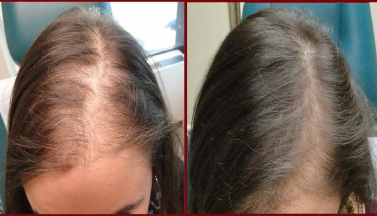 خلطة جد فعالة و مجربة للتخلص من الشعر الخفيف