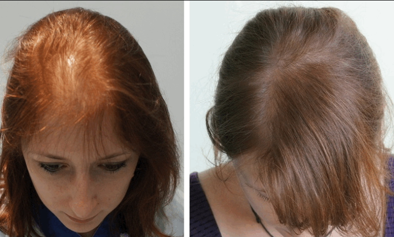 وصفة لعلاج تساقط الشعر والفراغات في مقدمة الرأس