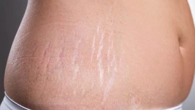 5 وصفات طبيعية لتقليل علامات تمدد الجلد
