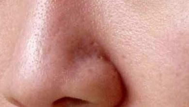 طرق طبيعية لعلاج وغلق مسامات الوجه والأنف