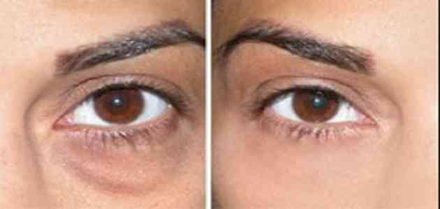 علاج الهالات السوداء او السواد تحت العين