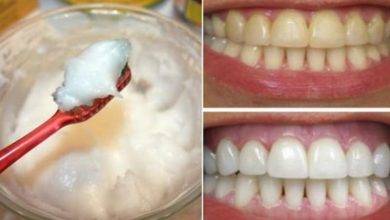 وصفة طبيعية للتخلص من إصفرار الأسنان وتبييضها
