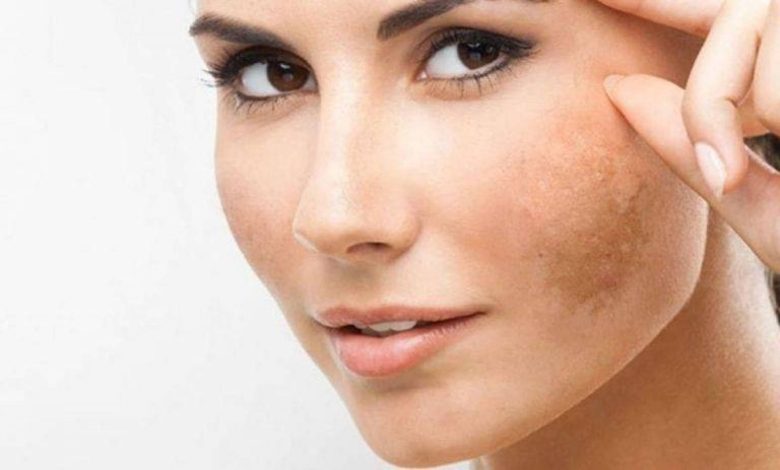 الطريقة الفضلى لعلاج التصبّغات الجلدية في الوجه