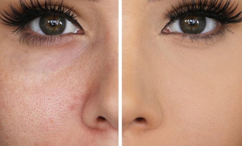 وصفات بسيطة لتنظيف مسام الوجه والتخلص منها